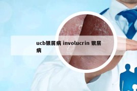ucb银屑病 involucrin 银屑病