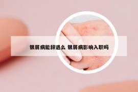 银屑病能辞退么 银屑病影响入职吗
