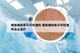 银屑病终身不可饮酒吗 银屑病终身不可饮酒吗怎么治疗