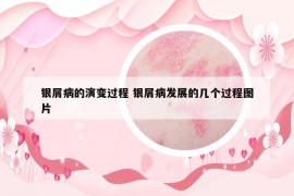 银屑病的演变过程 银屑病发展的几个过程图片