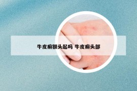 牛皮癣额头起吗 牛皮癣头部