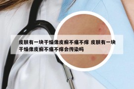 皮肤有一块干燥像皮癣不痛不痒 皮肤有一块干燥像皮癣不痛不痒会传染吗