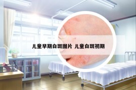 儿童早期白斑图片 儿童白斑初期