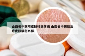 山西省中医院皮肤科银屑病 山西省中医院治疗皮肤病怎么样