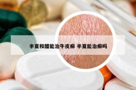 半夏和醋能治牛皮癣 半夏能治癣吗