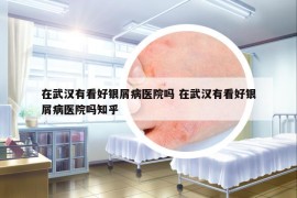 在武汉有看好银屑病医院吗 在武汉有看好银屑病医院吗知乎