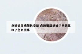 点滴银屑病颜色变淡 点滴银屑病好了两天又红了怎么回事