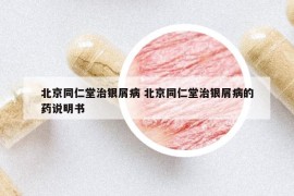 北京同仁堂治银屑病 北京同仁堂治银屑病的药说明书