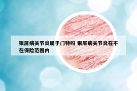 银屑病关节炎属于门特吗 银屑病关节炎在不在保险范围内