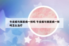 牛皮癣与银屑病一样吗 牛皮癣与银屑病一样吗怎么治疗