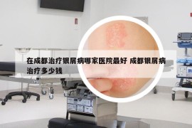 在成都治疗银屑病哪家医院最好 成都银屑病治疗多少钱