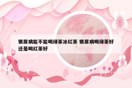 银屑病能不能喝绿茶冰红茶 银屑病喝绿茶好还是喝红茶好