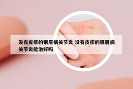 没有皮疹的银屑病关节炎 没有皮疹的银屑病关节炎能治好吗