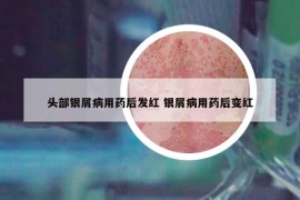 头部银屑病用药后发红 银屑病用药后变红