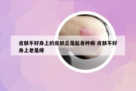 皮肤不好身上的皮肤总是起各种癣 皮肤不好身上老是痒