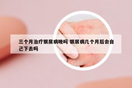 三个月治疗银屑病晚吗 银屑病几个月后会自己下去吗
