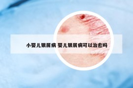 小婴儿银屑病 婴儿银屑病可以治愈吗