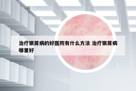 治疗银屑病的好医院有什么方法 治疗银屑病哪里好