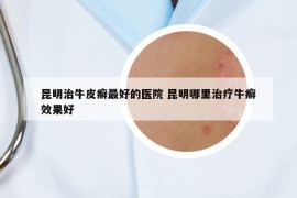 昆明治牛皮癣最好的医院 昆明哪里治疗牛癣效果好
