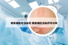 银屑病能吃活血药 银屑病吃活血药可以吗