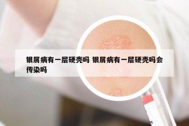 银屑病有一层硬壳吗 银屑病有一层硬壳吗会传染吗