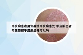 牛皮癣患者用生姜擦牛皮癣患处 牛皮癣患者用生姜擦牛皮癣患处可以吗