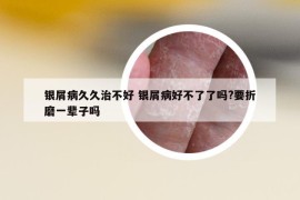 银屑病久久治不好 银屑病好不了了吗?要折磨一辈子吗
