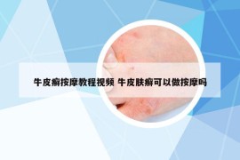 牛皮癣按摩教程视频 牛皮肤癣可以做按摩吗