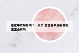 爸爸牛皮癣影响下一代么 爸爸有牛皮癣生的宝宝会有吗