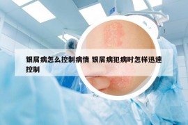 银屑病怎么控制病情 银屑病犯病时怎样迅速控制