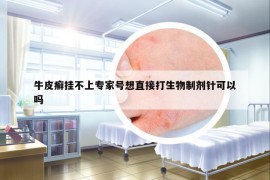 牛皮癣挂不上专家号想直接打生物制剂针可以吗