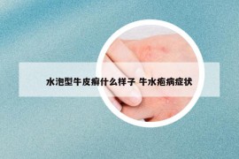 水泡型牛皮癣什么样子 牛水疱病症状