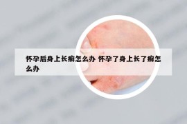 怀孕后身上长癣怎么办 怀孕了身上长了癣怎么办