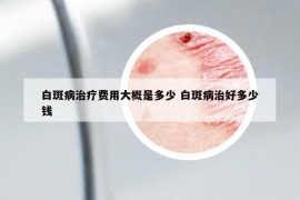 白斑病治疗费用大概是多少 白斑病治好多少钱