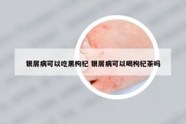 银屑病可以吃黑枸杞 银屑病可以喝枸杞茶吗