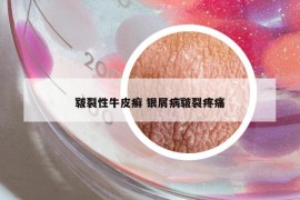 皲裂性牛皮癣 银屑病皲裂疼痛