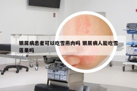 银屑病患者可以吃雪燕肉吗 银屑病人能吃雪莲果吗