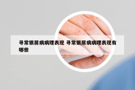 寻常银屑病病理表现 寻常银屑病病理表现有哪些