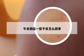 牛皮癣起一层干皮怎么回事