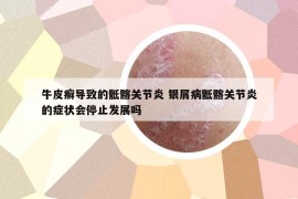 牛皮癣导致的骶髂关节炎 银屑病骶髂关节炎的症状会停止发展吗