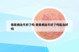 银屑病治不好了吗 银屑病治不好了吗能治好吗