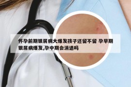 怀孕前期银屑病大爆发孩子还留不留 孕早期银屑病爆发,孕中期会消退吗