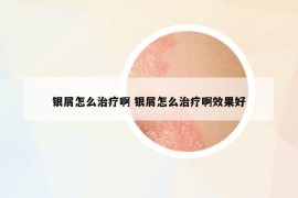 银屑怎么治疗啊 银屑怎么治疗啊效果好