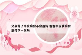 父亲得了牛皮癣会不会遗传 爸爸牛皮肤癣会遗传下一代吗