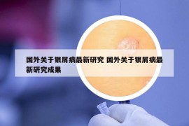 国外关于银屑病最新研究 国外关于银屑病最新研究成果