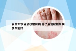 女生22岁点滴状银屑病 得了点滴状银屑病多久能好