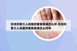 杭州市第三人民医院看银屑病怎么样 杭州市第三人民医院看银屑病怎么样啊