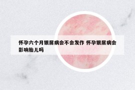 怀孕六个月银屑病会不会发作 怀孕银屑病会影响胎儿吗