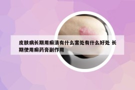 皮肤病长期用癣清有什么害处有什么好处 长期使用癣药膏副作用