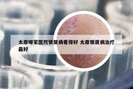 太原哪家医院银屑病看得好 太原银屑病治疗最好